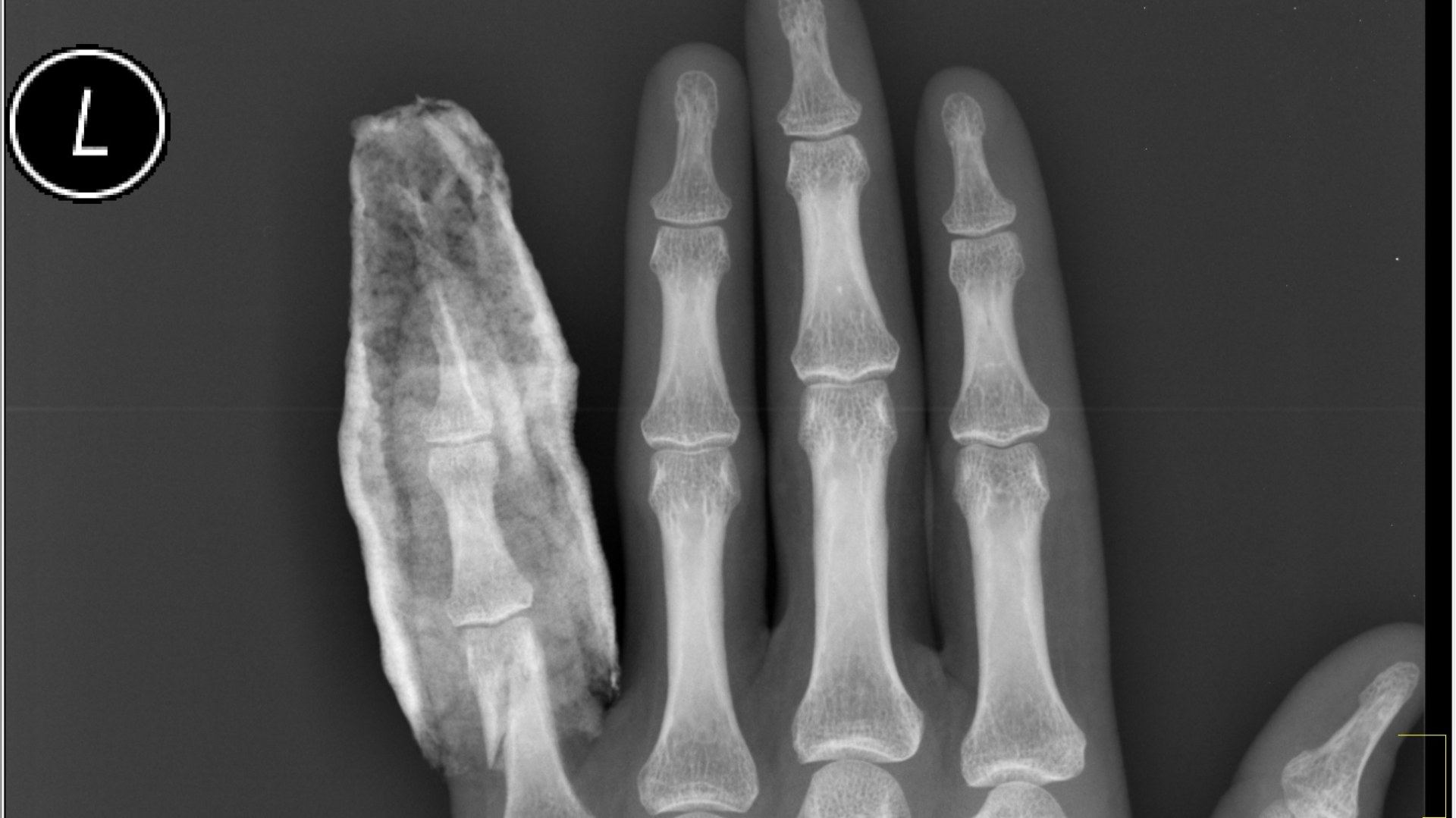 X-ray of a hand showing a fractured little finger held in a splint