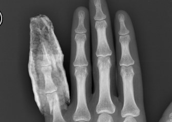 X-ray of a hand showing a fractured little finger held in a splint