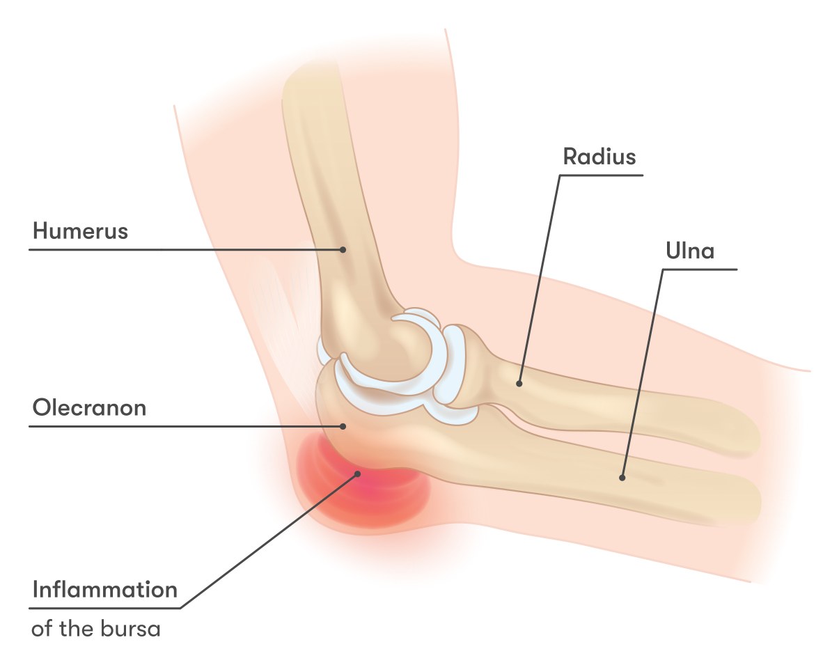Diagram of the elbow showing the humerus, radius, ulna and olecranon, with the inflamed olecranon bursa at the tip of the elbow