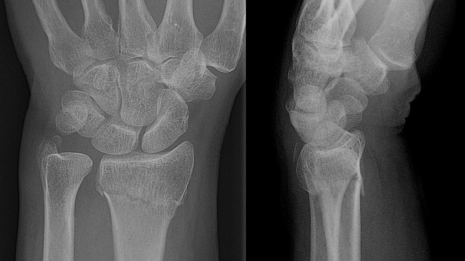 X-ray of a wrist showing a broken distal radius, front and side views