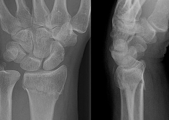 X-ray of a wrist showing a broken distal radius, front and side views