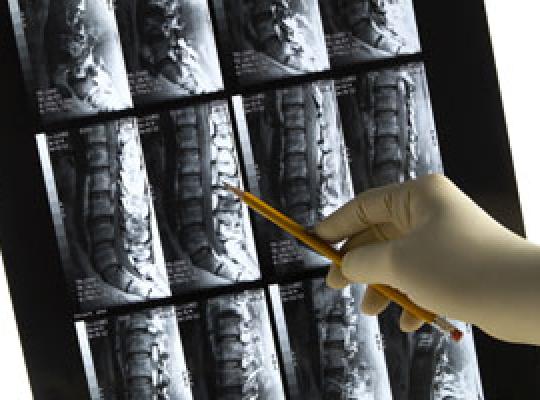 spine colman implants