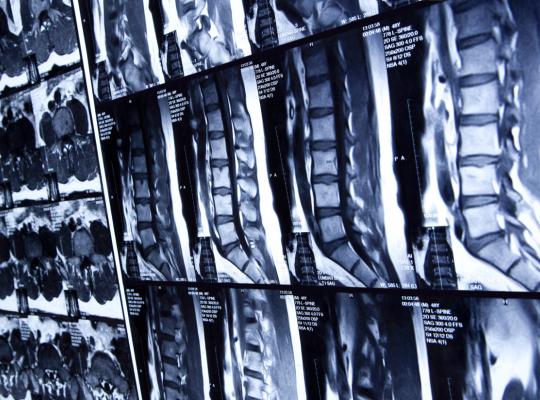 MRI scan of lumbar spine