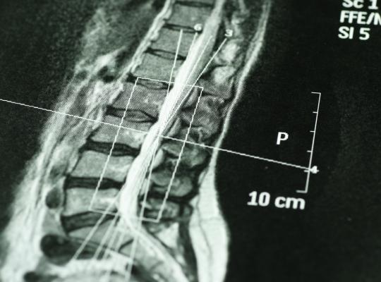 MRI scan of a spine