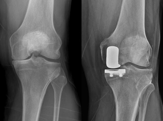 X-ray of partial knee replacement